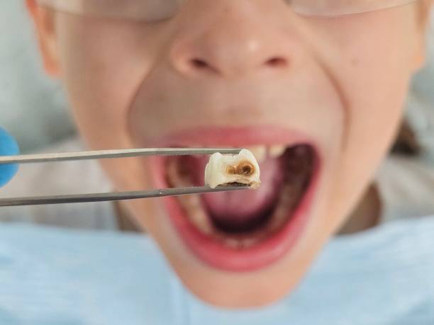 Best Emergency Wisdom Teeth Removal in San Luis, AZ